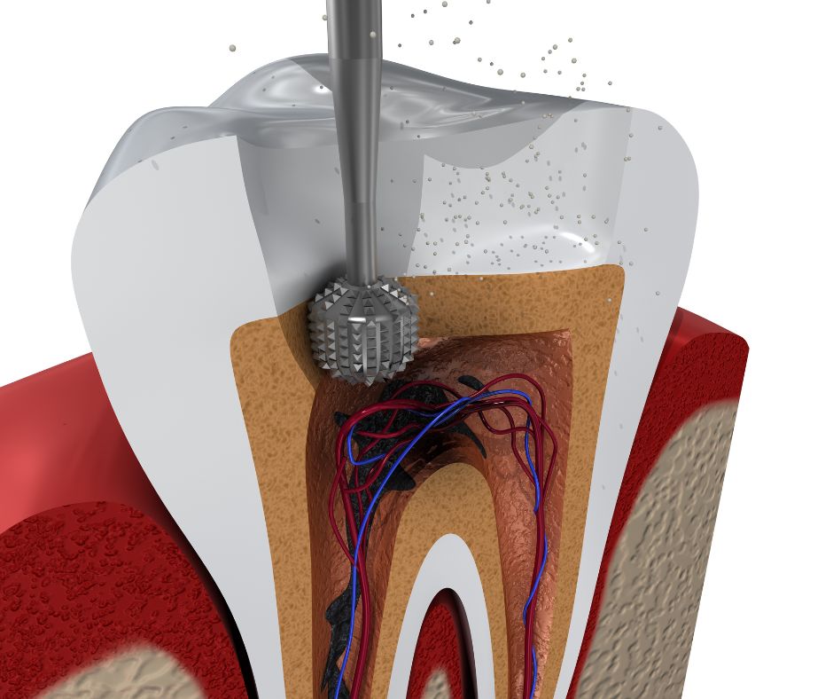 Root Canal Treatment image